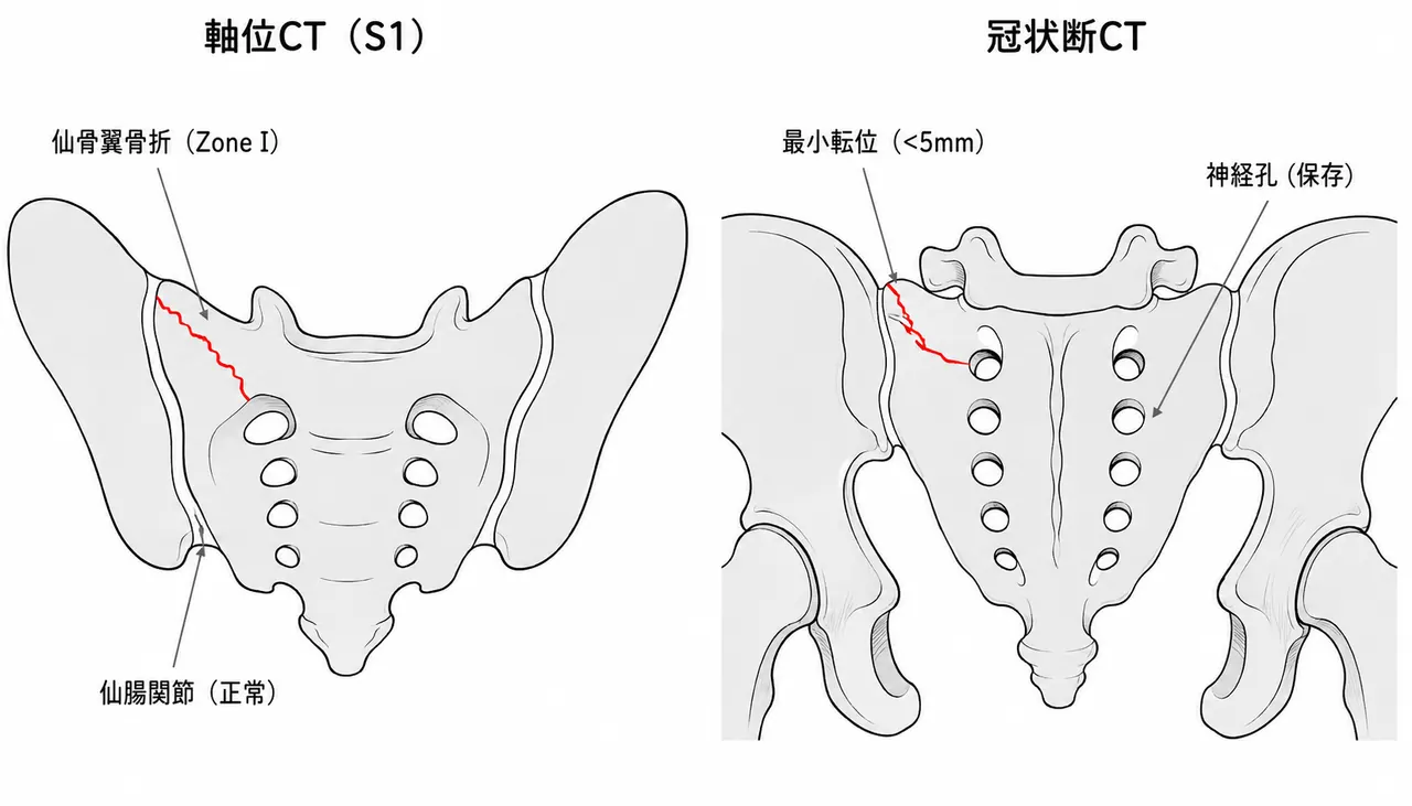 CT軸位断・冠状断 — 仙骨骨折帯と転位量の評価