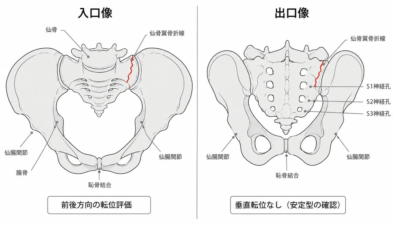 骨盤入口像（Inlet）・出口像（Outlet）— 仙骨の前後・上下転位評価