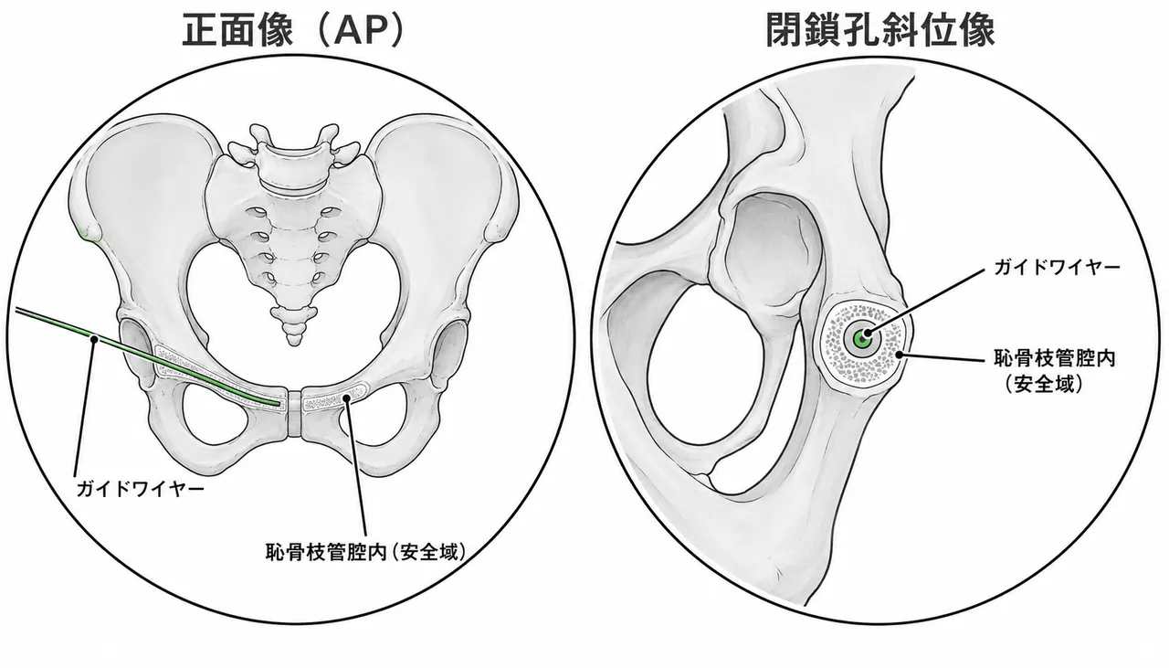 経皮的恥骨枝スクリュー固定の術中透視像 — ガイドワイヤー位置確認（AP/obturator oblique）