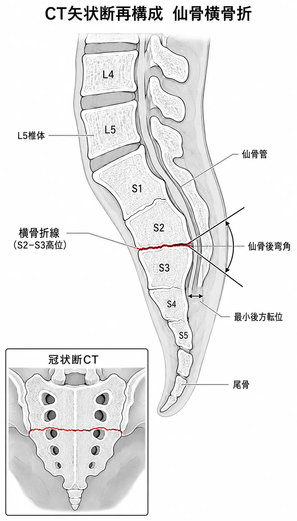 CT矢状断像 — 仙骨横骨折の転位・神経管狭窄評価