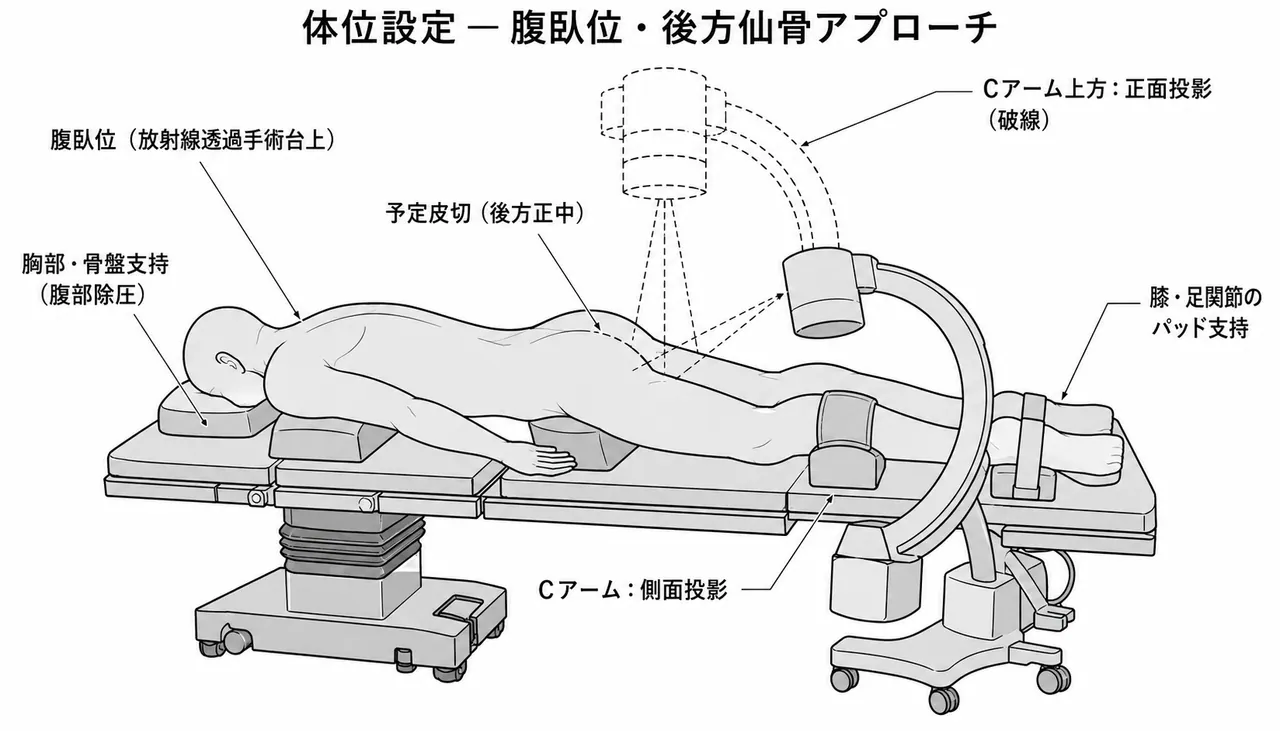 手術体位 — 腹臥位と後方アプローチのセットアップ