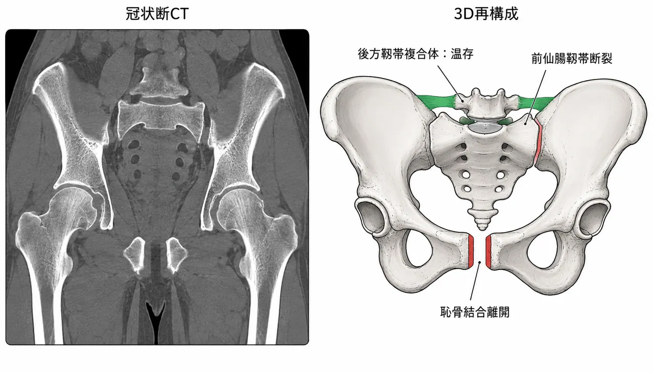 骨盤CT冠状断＋3D再構成 — 前仙腸関節靱帯断裂・後方靱帯複合体温存の評価