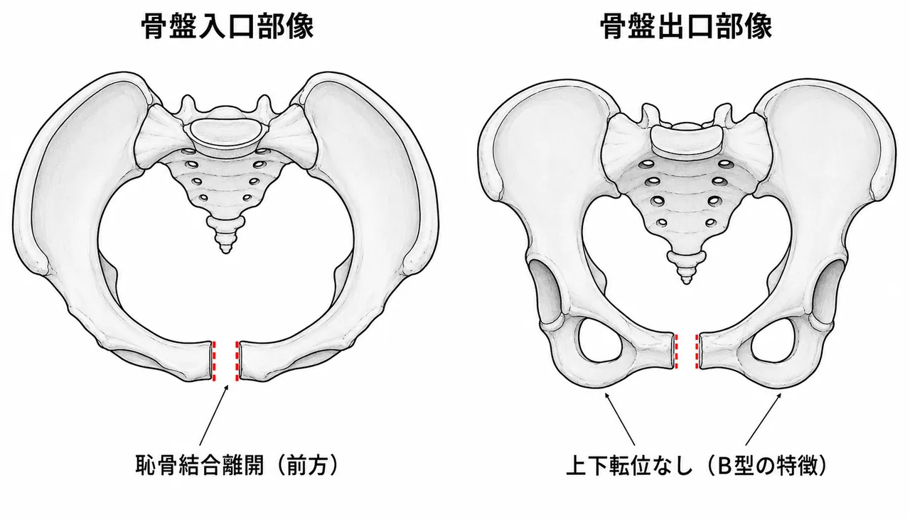 骨盤inlet/outlet View — 骨盤輪の変形パターン評価