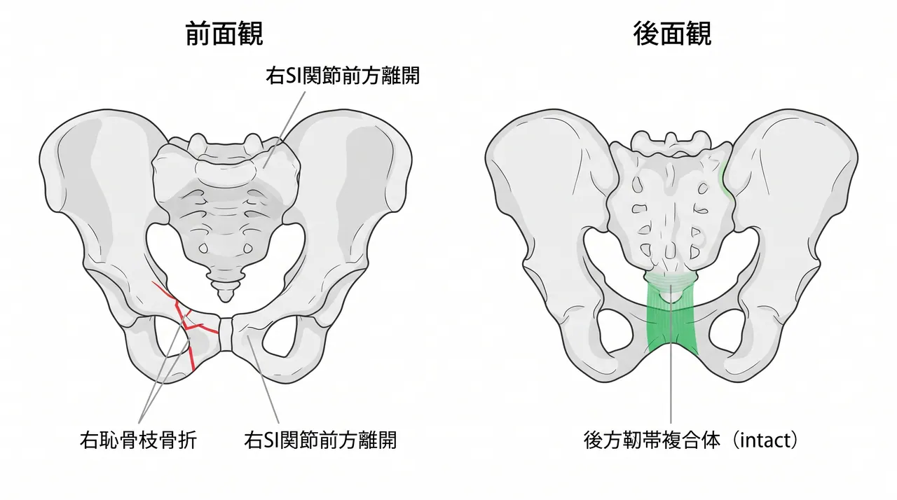 骨盤CT 3D再構成 — 前方損傷パターンと後方安定性の把握