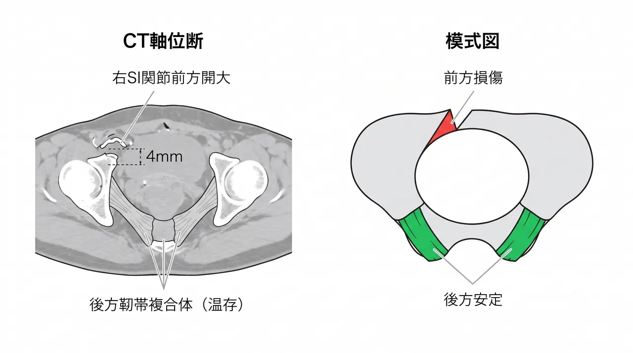 骨盤CT軸位断 — 患側仙腸関節前方開大と後方靱帯温存の確認