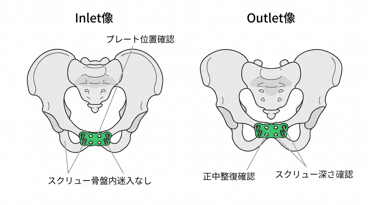 恥骨結合プレート固定術中透視 — inlet/outlet像での確認