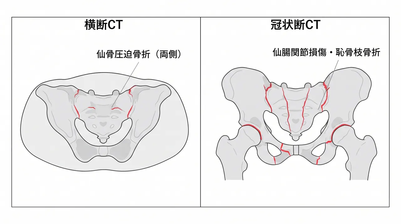 CT横断像・冠状断像 — 両側仙骨骨折（ZoneI〜II）・仙腸関節損傷・前方骨盤輪骨折の評価