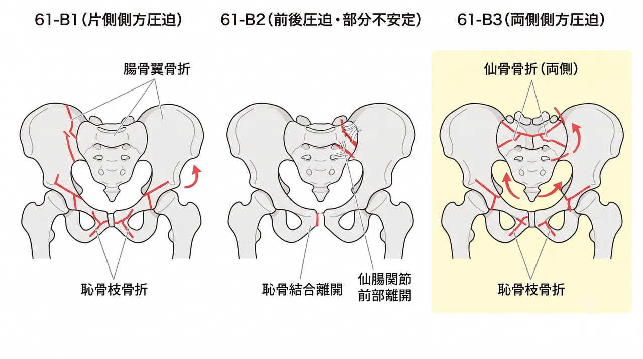 骨盤輪骨折AO分類比較 — 61-B1（側方圧迫片側）vs 61-B2（前後圧迫部分不安定）vs 61-B3（側方圧迫両側）の3パネル模式図