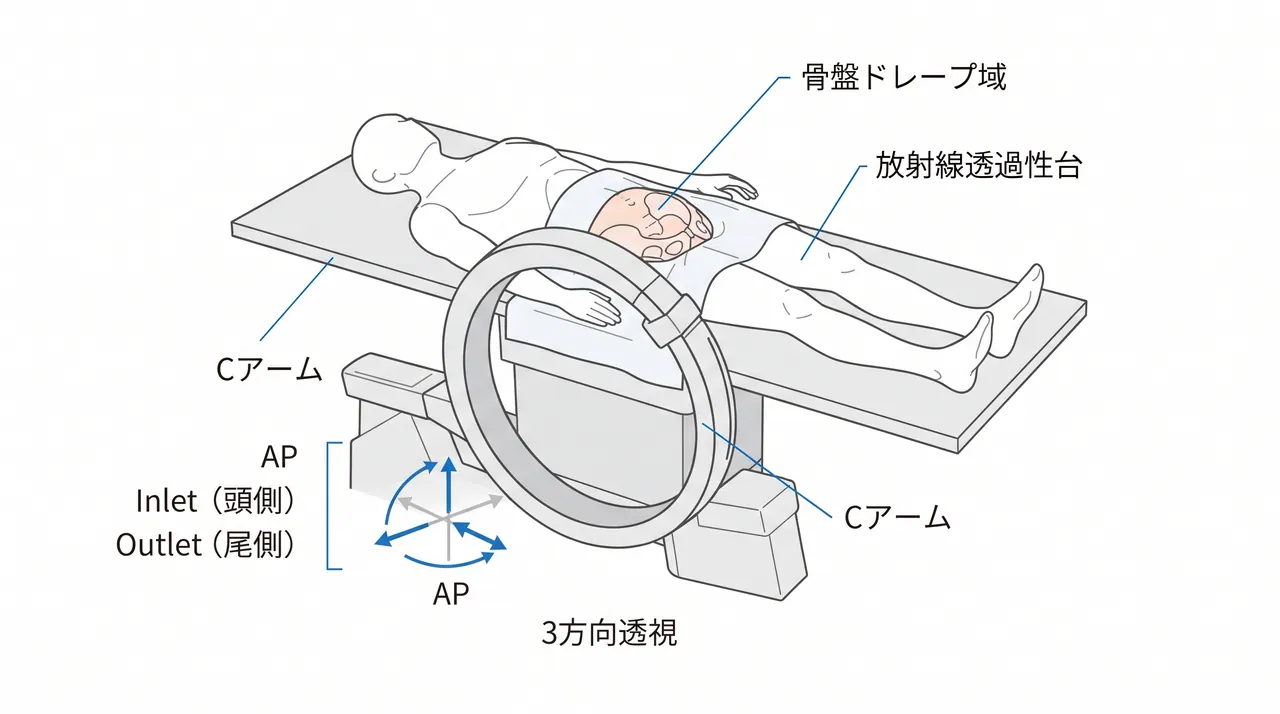 手術体位 — 仰臥位・骨盤透視対応カーボン台・C型アームのAP/Inlet/Outlet方向確認