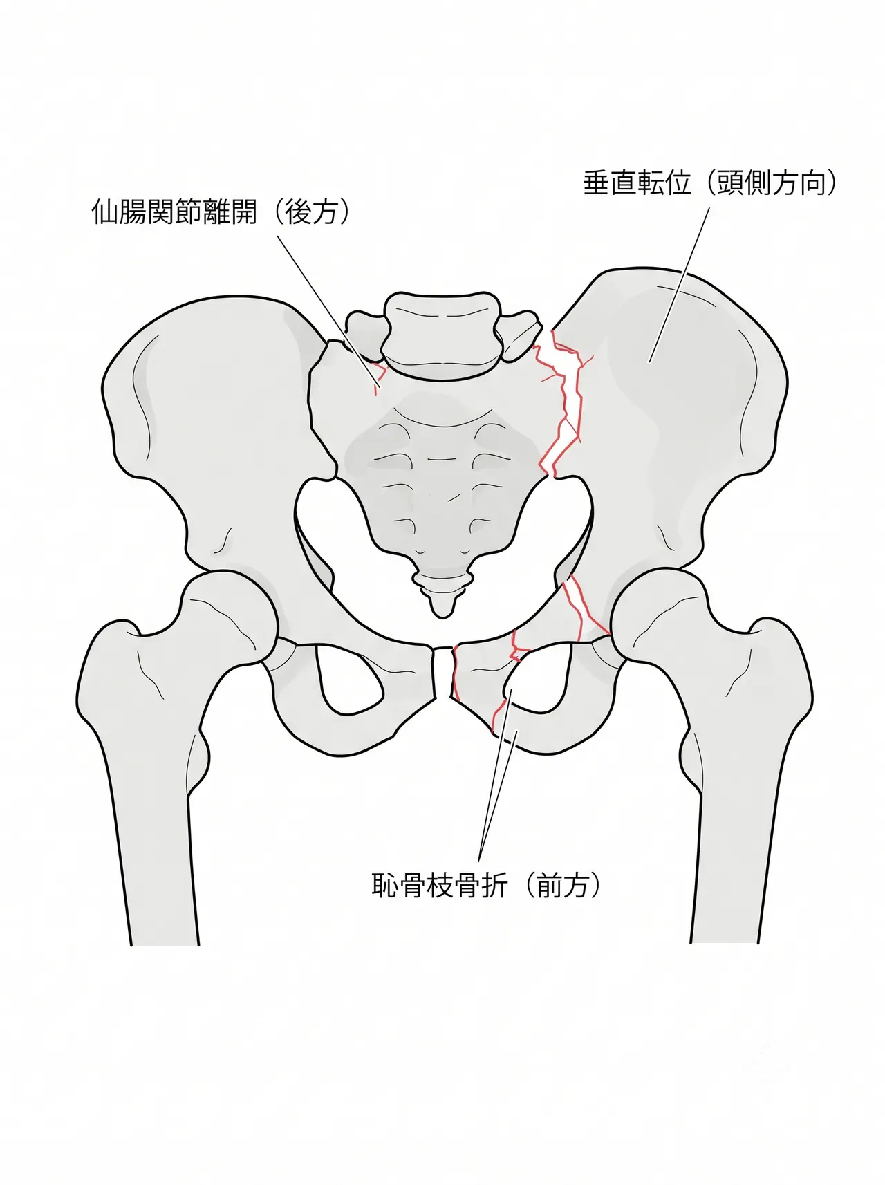 X線AP像 — 片側骨盤半環の垂直転位と恥骨枝骨折