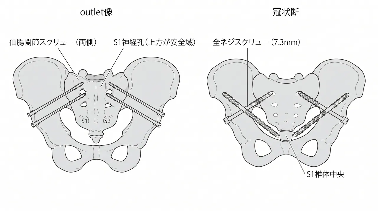 仙腸関節スクリュー固定模式図 — 両側経皮的固定・仙骨S1ゾーン