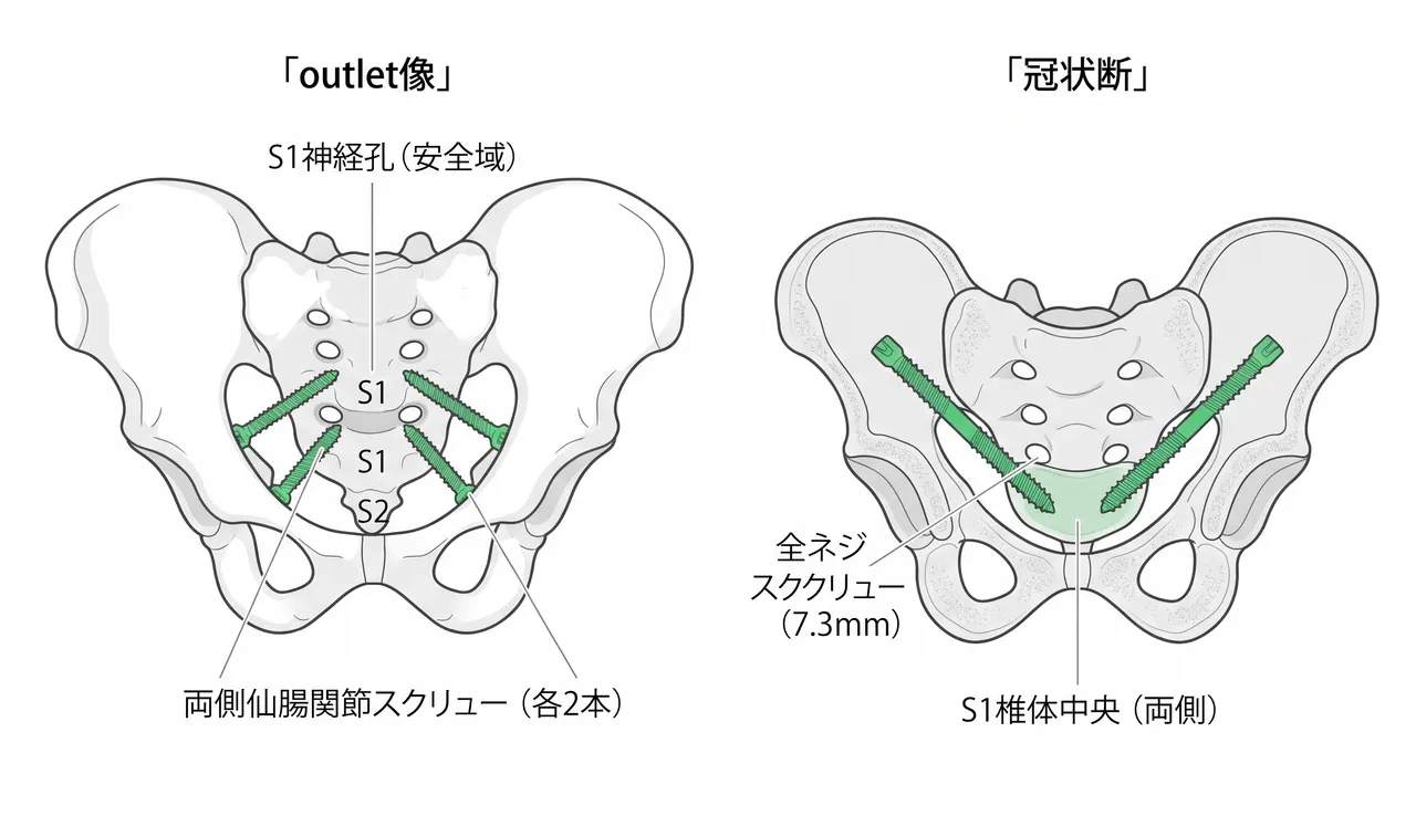 両側仙腸関節スクリュー固定模式図 — 両側S1・S2ゾーン経皮的固定
