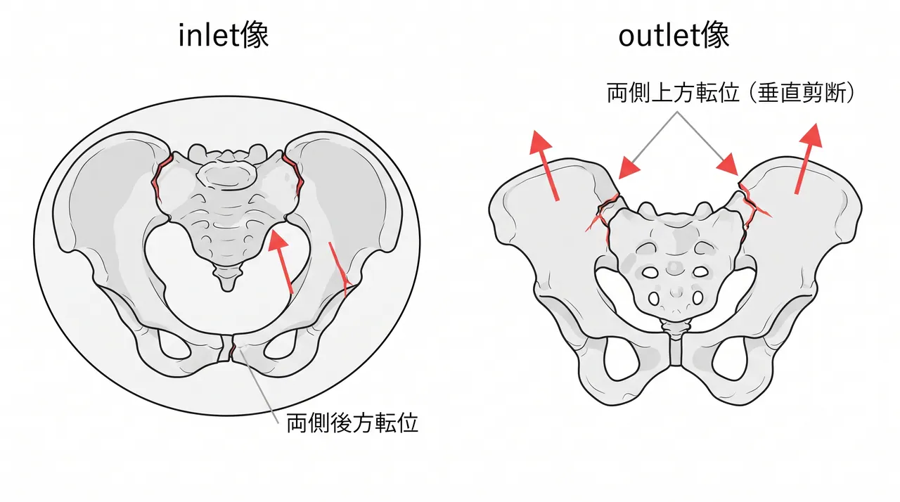 Inlet/Outlet像 — 両側垂直転位・回旋転位の定量的評価