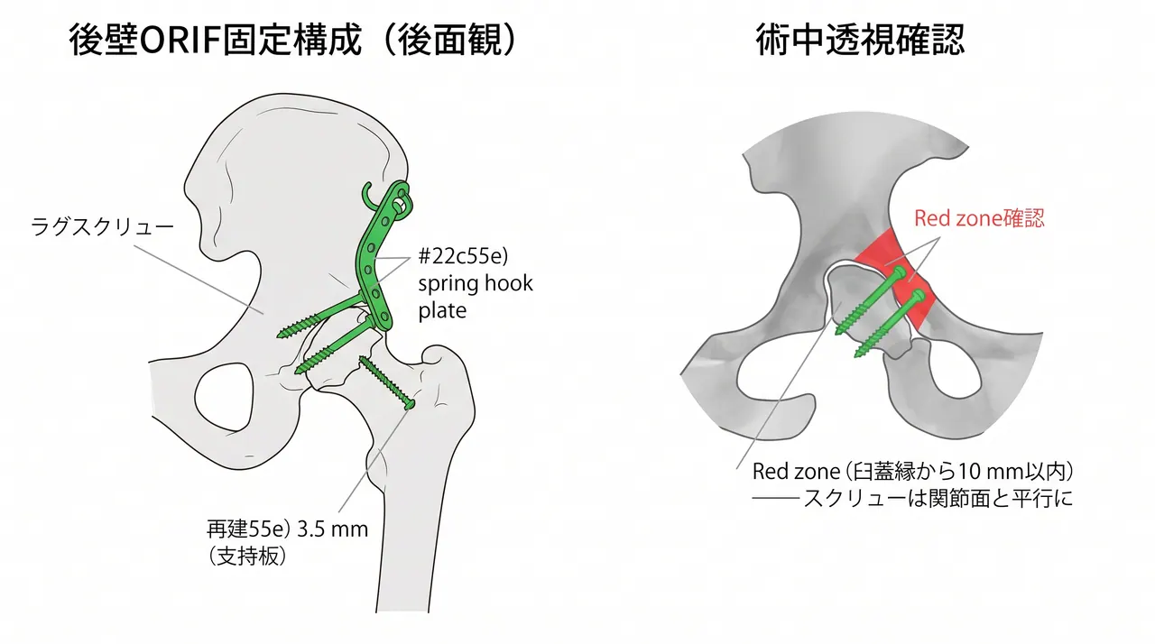 固定構成 — 後壁骨折ラグスクリュー＋再建プレート（支持板）の配置と透視確認