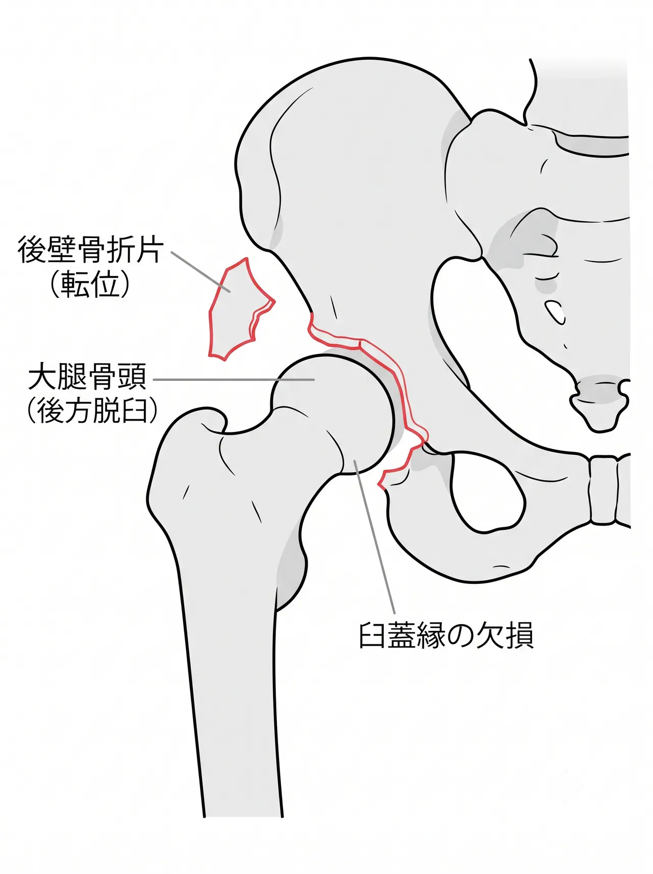 X線正面像 — 股関節後方脱臼を伴う臼蓋後壁骨折（骨折片の転位）