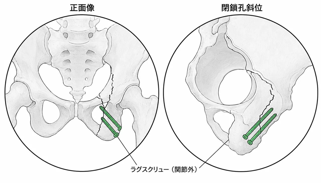術中透視（AP・閉鎖孔斜位）— 後柱ラグスクリューの刺入方向確認