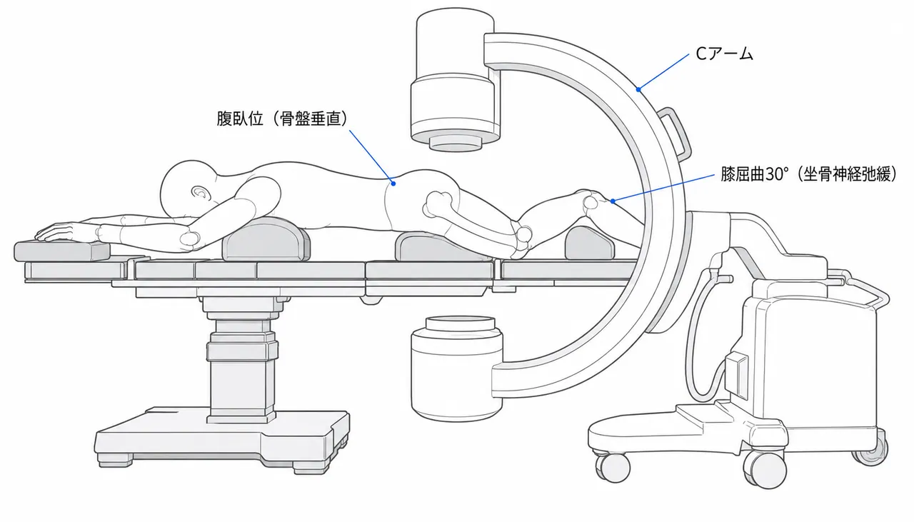 手術体位（腹臥位）— Kocher-Langenbeck アプローチの標準セットアップ
