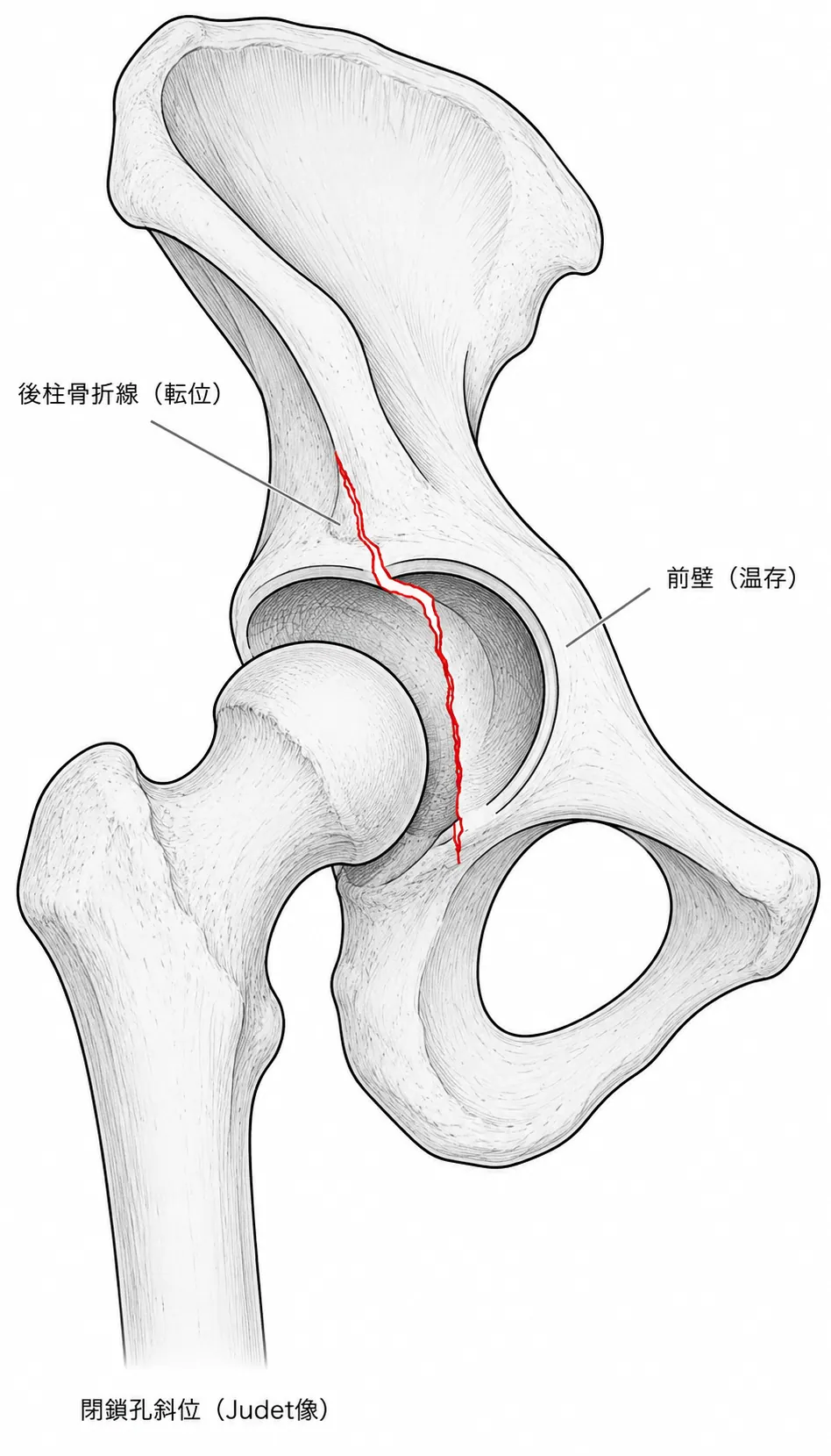 Judet像（閉鎖孔斜位）— 後柱骨折線の描出