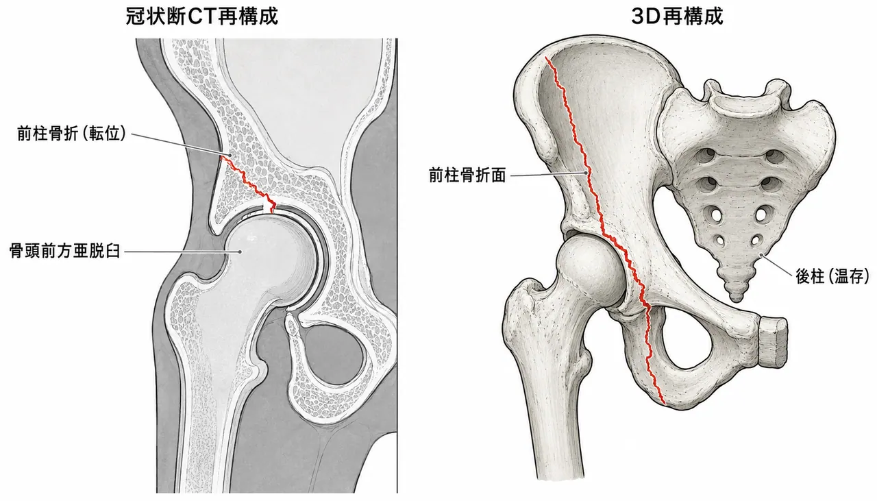 CT軸位断・冠状断 — 前柱骨折の転位量・関節内遊離体・亜脱臼方向の評価