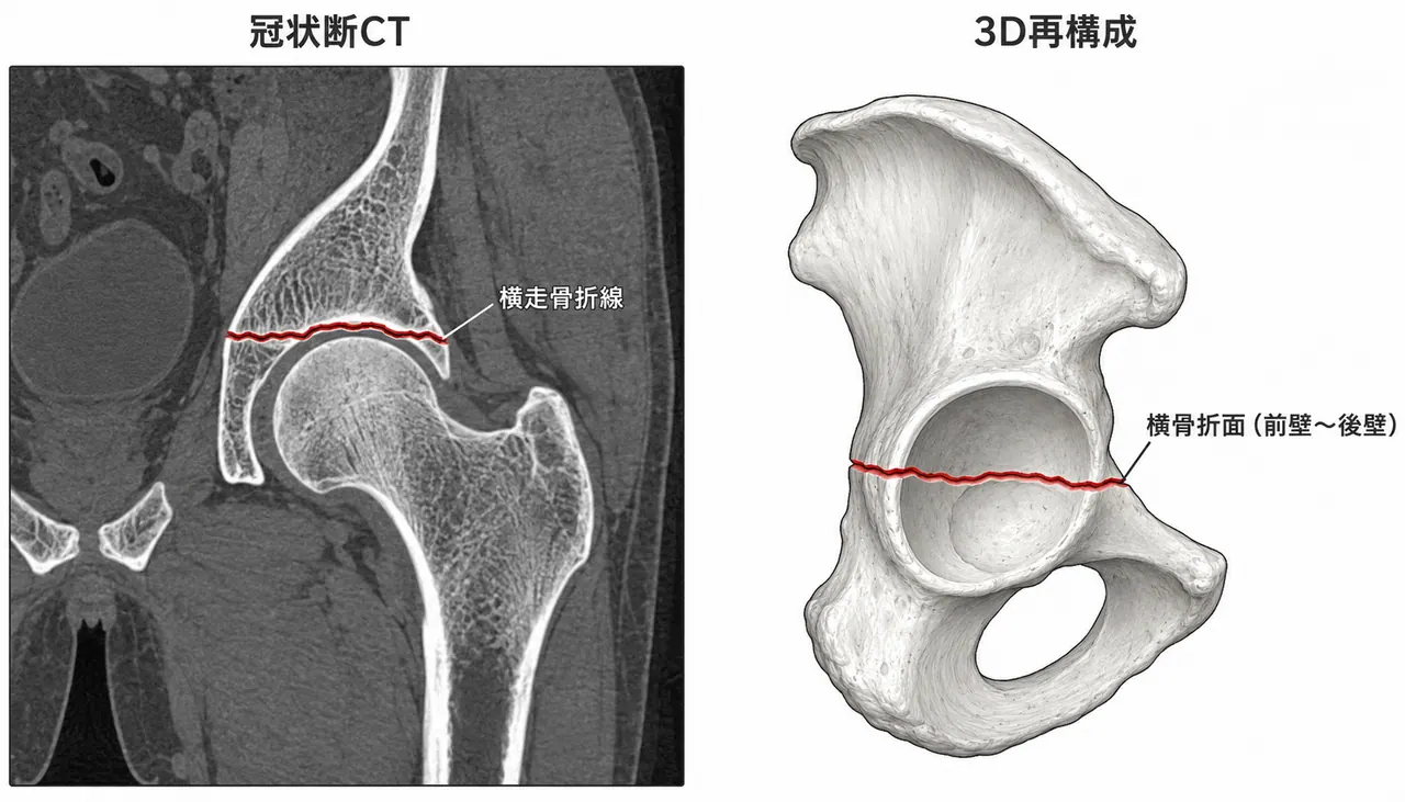 骨盤CT冠状断＋3D再構成 — 横骨折線の走行・荷重ドームとの位置関係評価