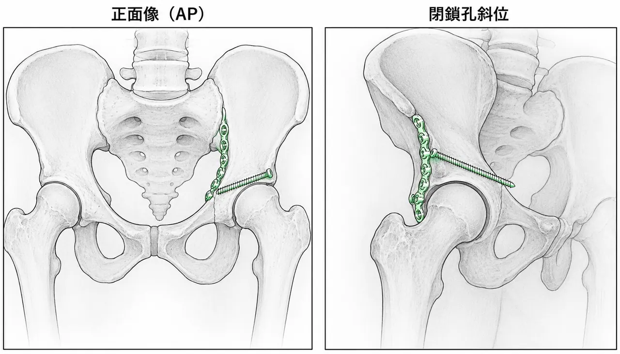 術後骨盤X線像（AP/Judet斜位）— 後柱プレート＋前柱ラグスクリュー固定後の整復位確認