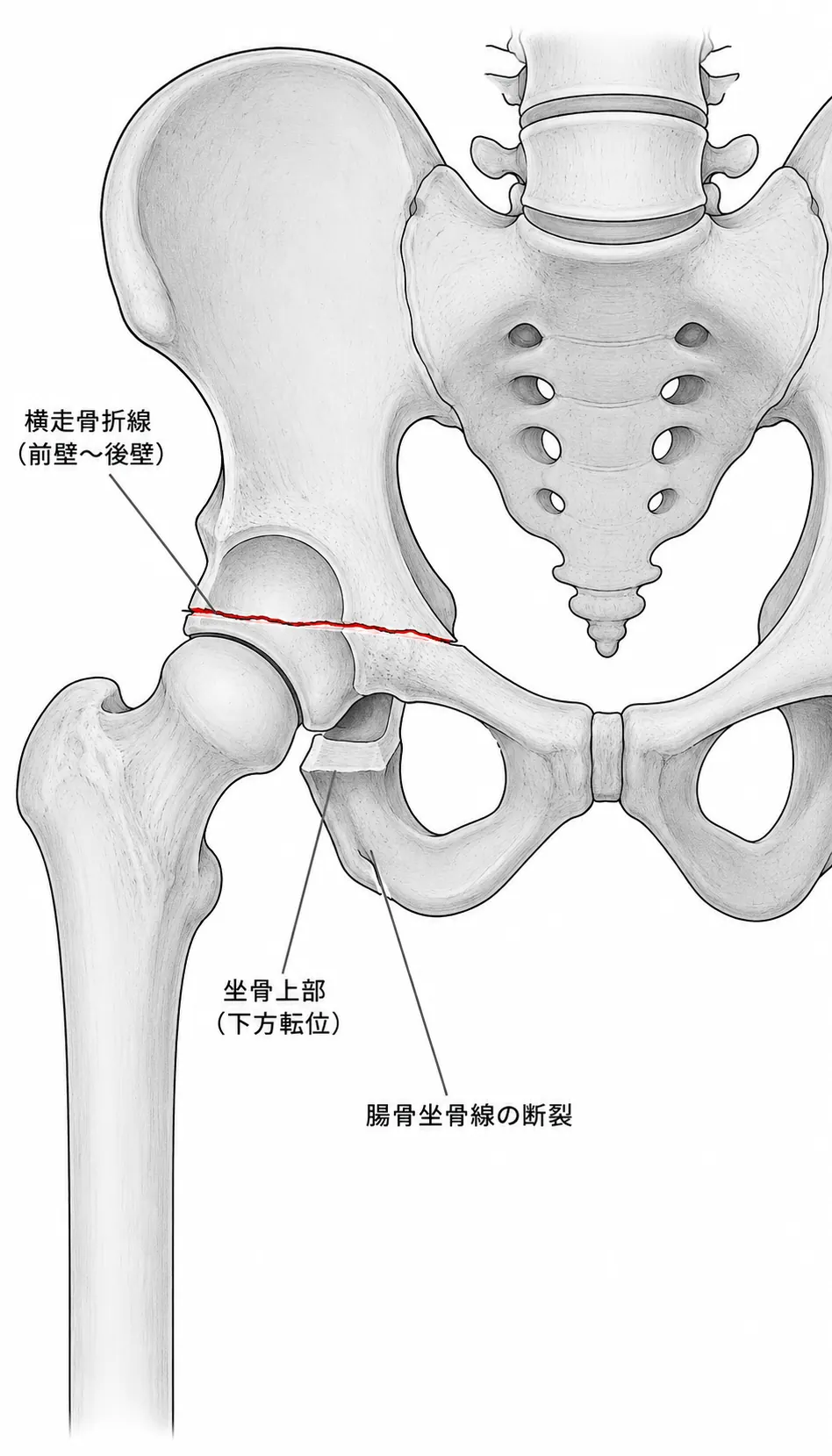 骨盤AP単純X線像 — 臼蓋横走骨折線（前・後柱同時断裂）