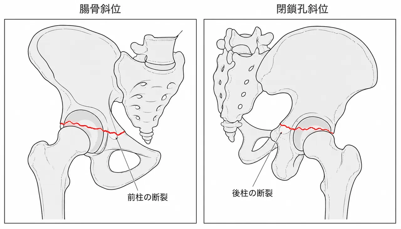Judet斜位像（腸骨斜位 + 閉鎖孔斜位）— 前・後柱の断裂パターン評価
