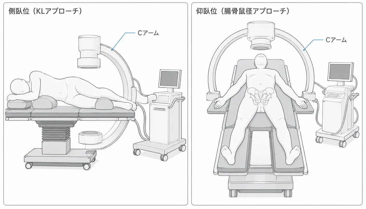 手術体位 — Kocher-Langenbeckアプローチ（側臥位）または腸骨鼠径アプローチ（仰臥位）