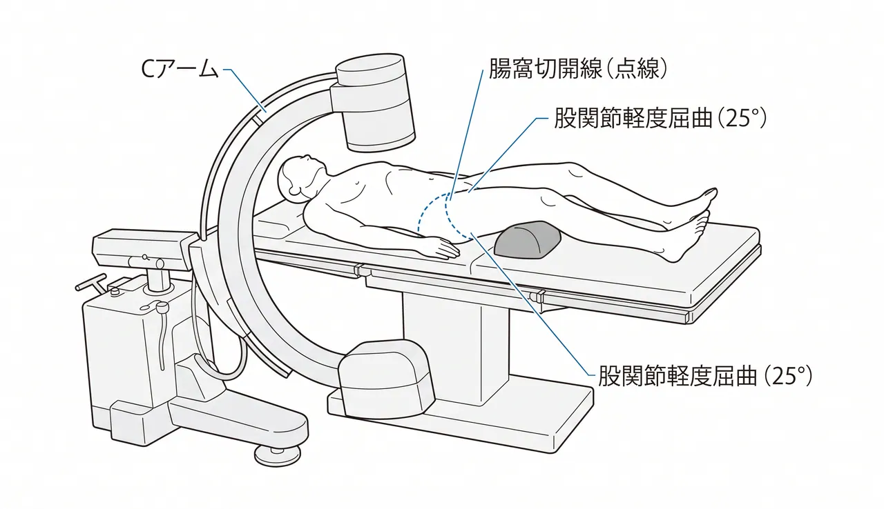 手術体位（仰臥位）— 腸骨鼠径アプローチ：骨折台または通常手術台、Cアームセットアップ
