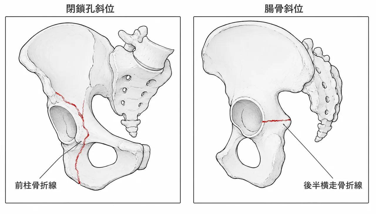 Judet斜位2方向 — 閉鎖孔斜位（前柱評価）と腸骨斜位（後半横走成分評価）