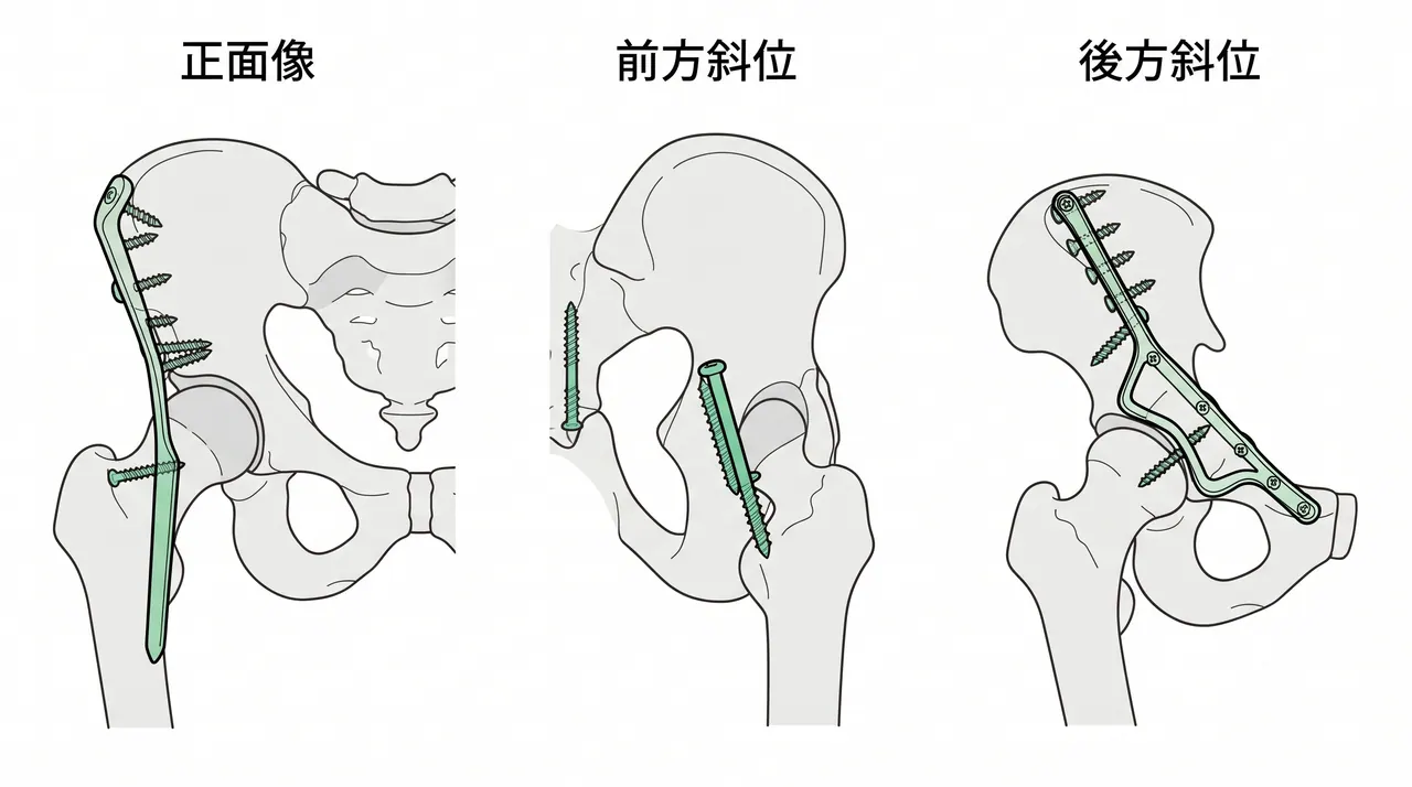 術中透視 — Judet 3方向でのプレート・スクリュー位置確認
