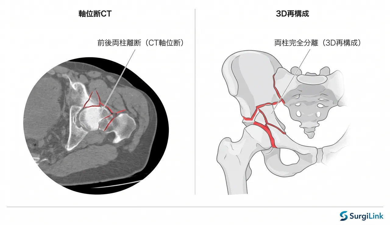 CT 3D再構成 — 前後両柱の完全離断・骨折パターン・後壁合併の評価