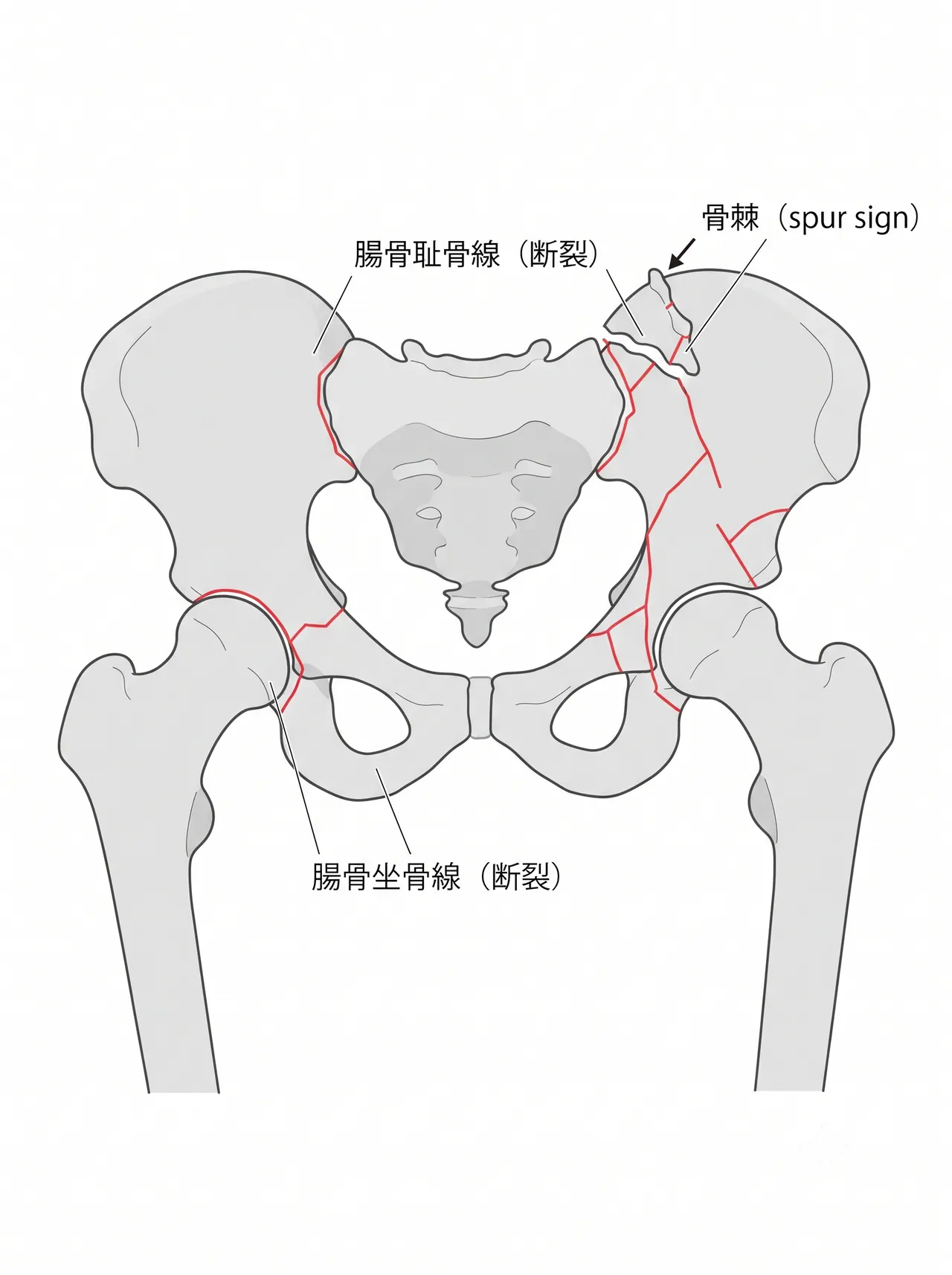 骨盤正面X線 — 両柱骨折による腸骨耻骨線・坐骨耻骨線の両断・股関節内側化とspur sign