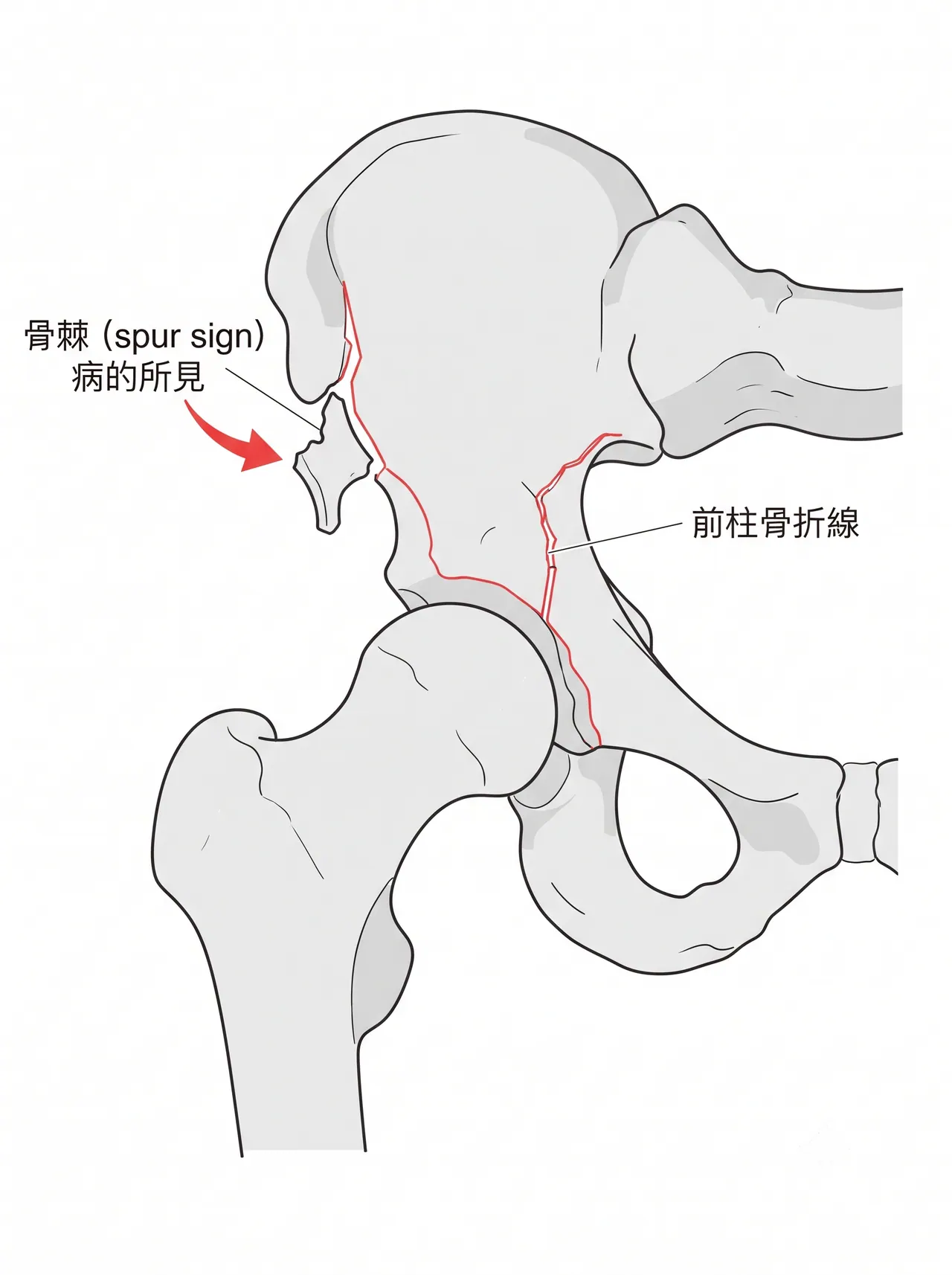 閉鎖孔斜位X線 — Spur sign（腸骨翼最遠位骨片）の可視化・前柱骨折線の評価