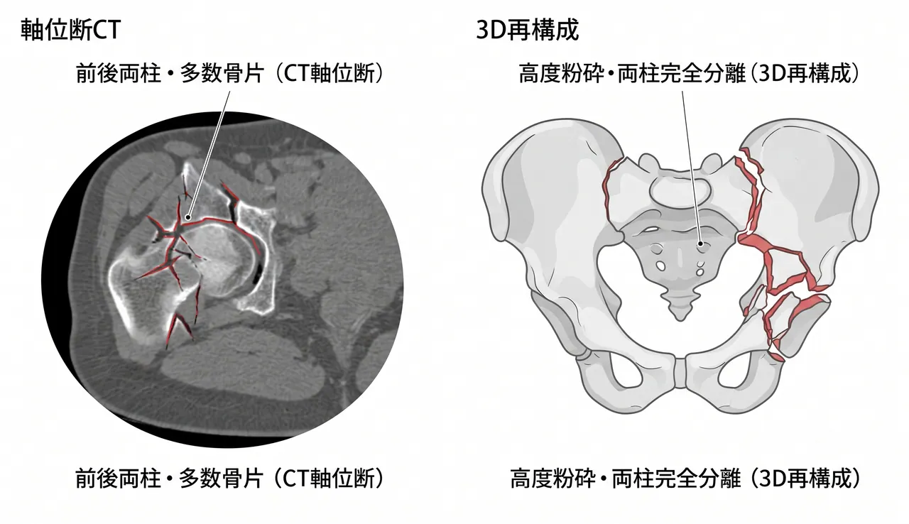 CT 3D再構成 — 前後両柱の多数骨片・高度粉砕パターン・関節面の断裂