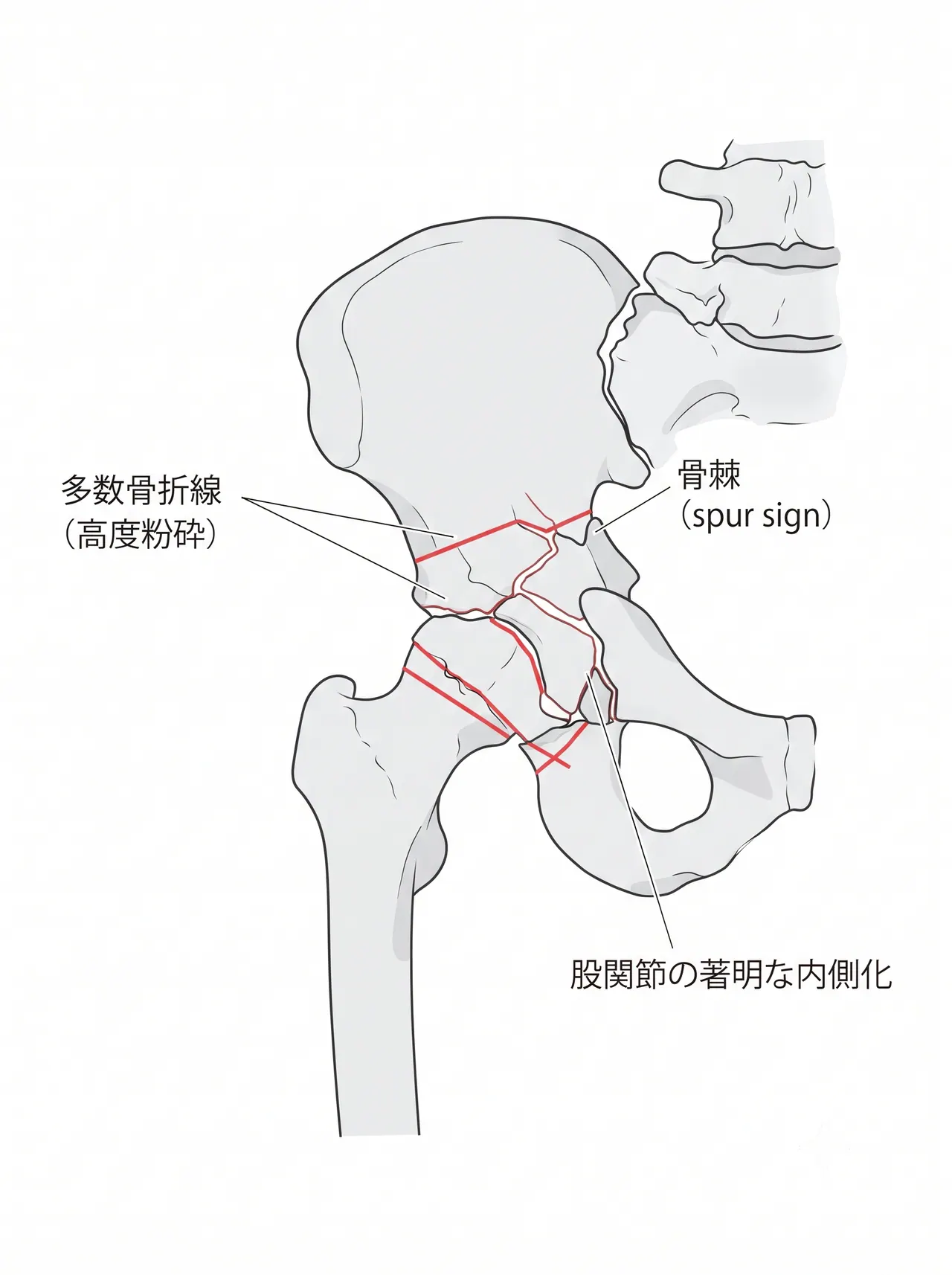 骨盤正面X線 — 両柱高度粉砕による多数骨折線・高度の股関節内側化とspur sign