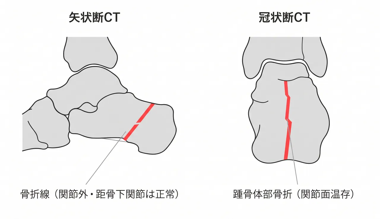 CT矢状断・冠状断 — 骨折線の走行・距骨下関節面への波及の有無・骨片転位量の三次元評価