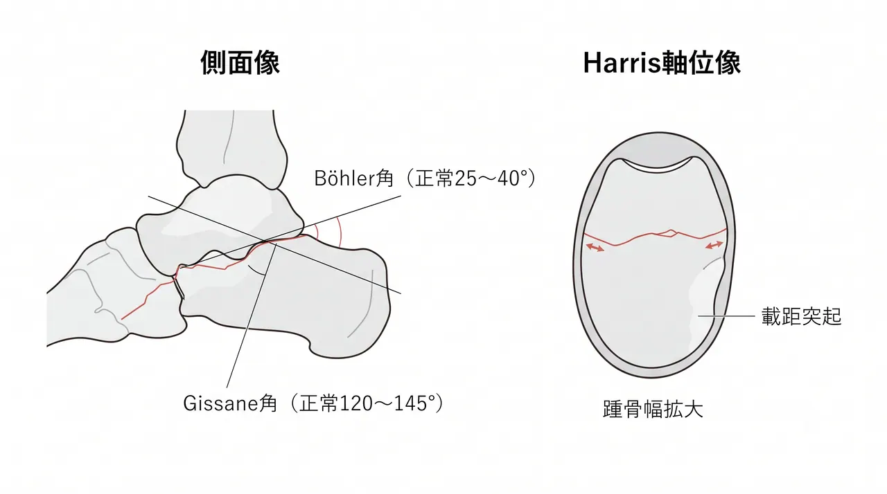 術前X線側面像・Harris軸位像 — Böhler角・Gissane角計測、踵骨幅拡大・転位量評価