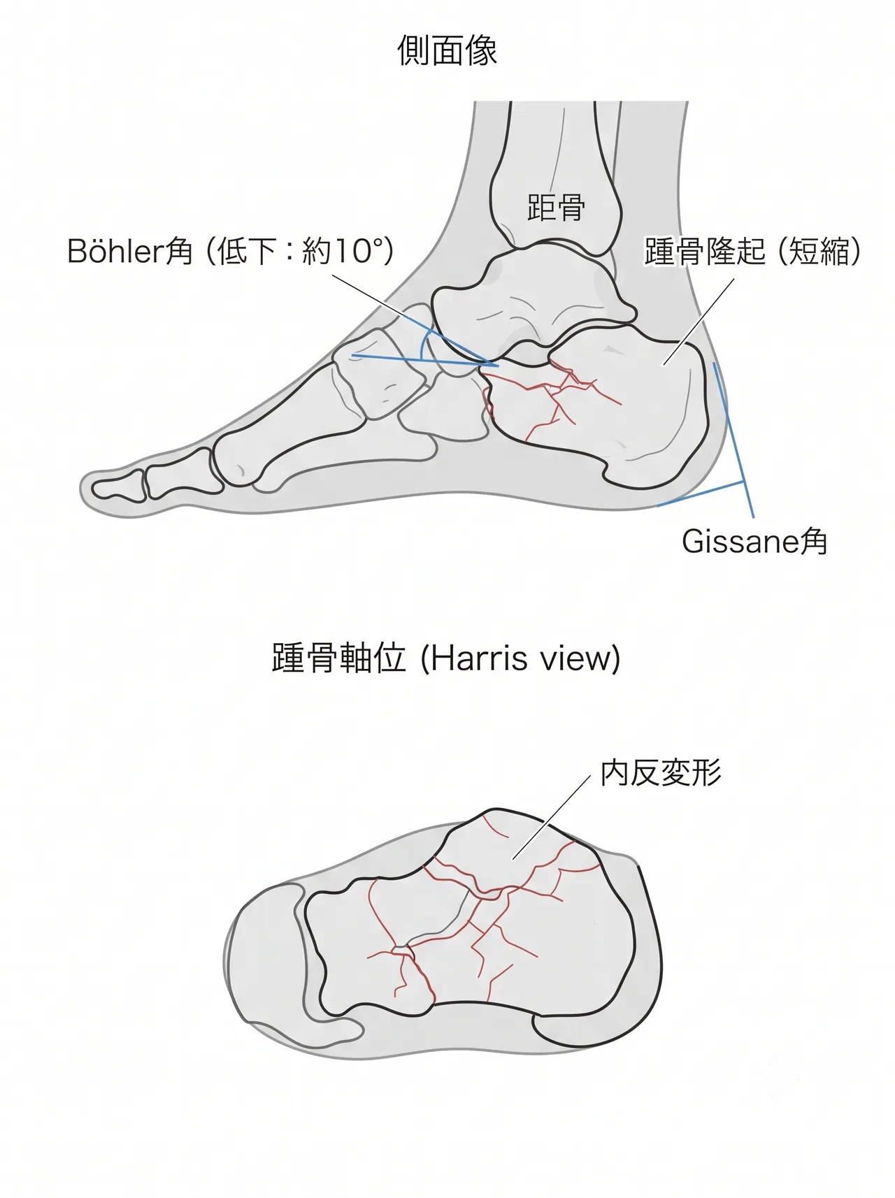 71-a2-xray-preop.png