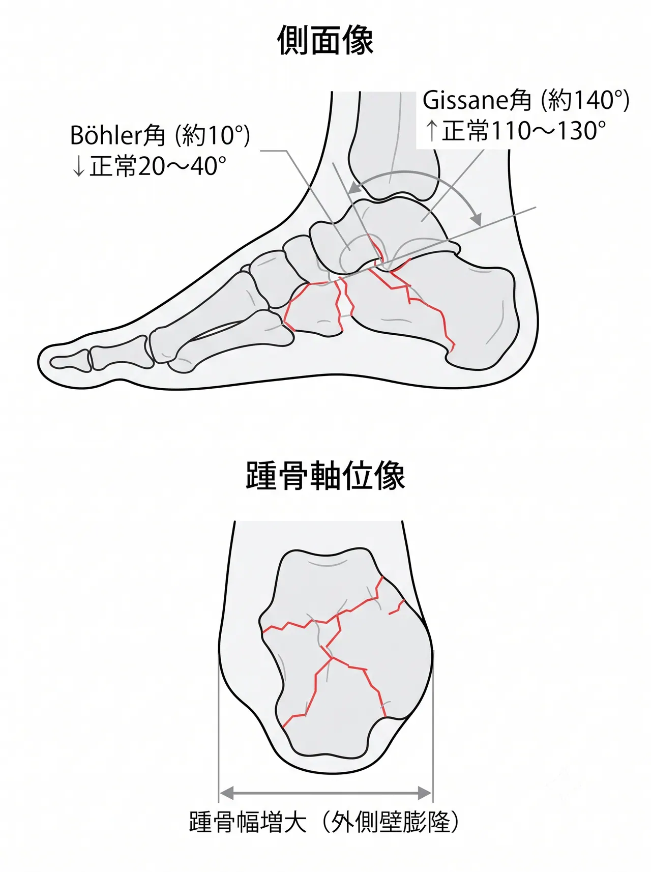 術前X線側面像・Harris view（踵骨軸位像） — Böhler角・Gissane角の計測。踵骨の高さ・幅・後距骨下関節面の評価