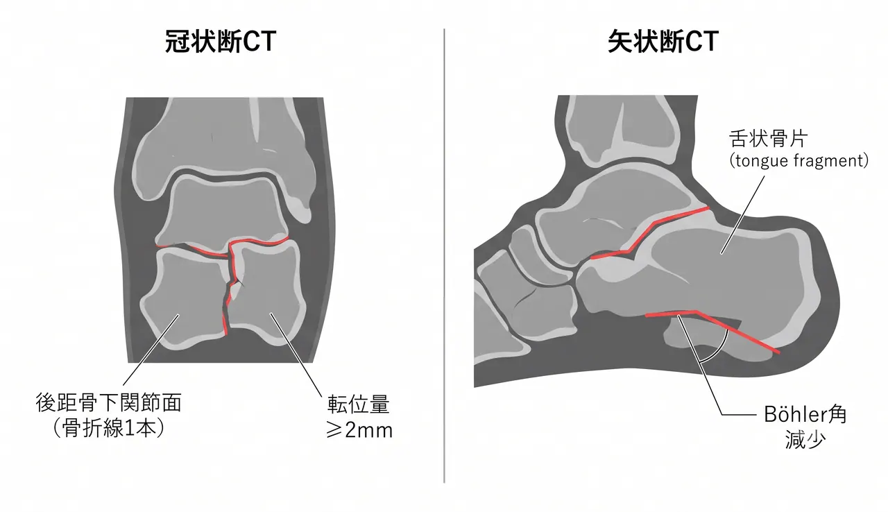 CT冠状断・矢状断 — Sanders II骨折線パターン・後距骨下関節面転位量・舌状骨片の確認