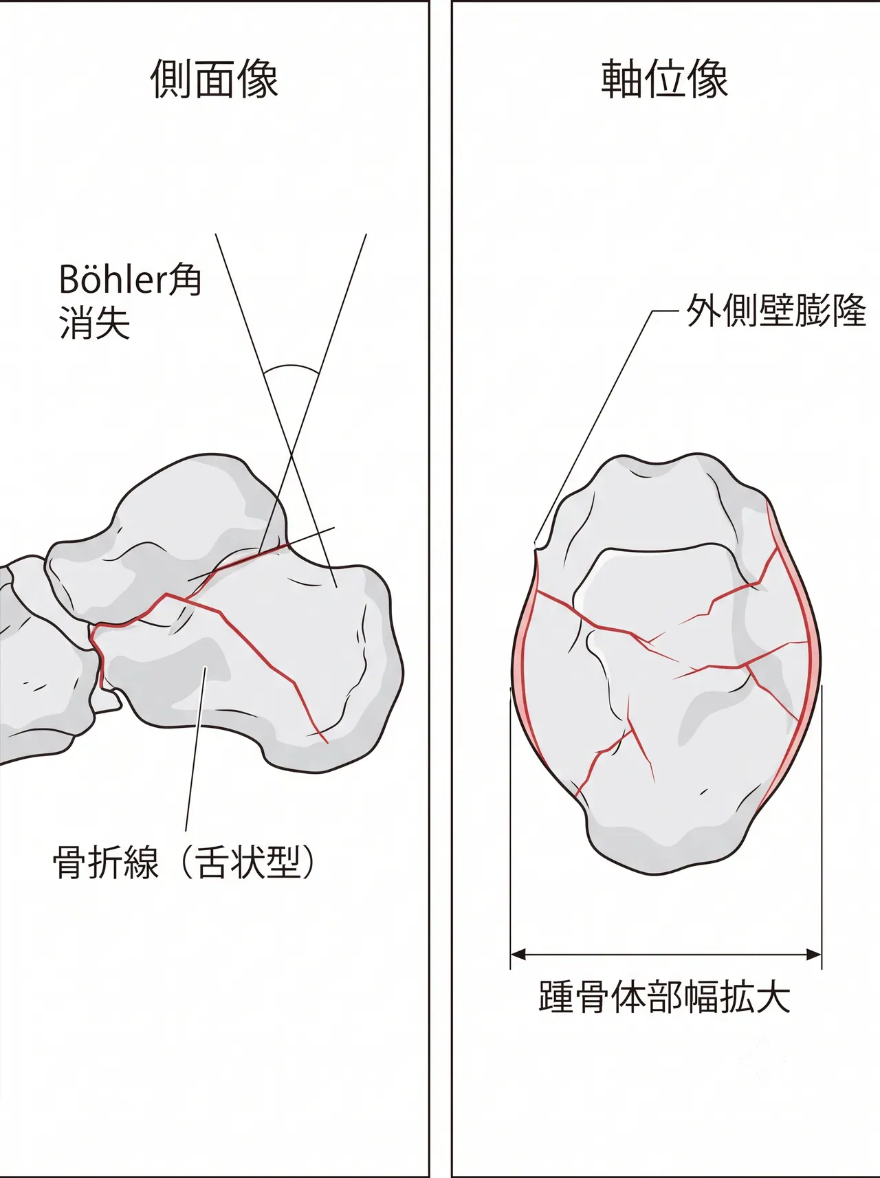 術前X線側面像・軸位像（Harris view） — Böhler角消失・外側壁膨隆・踵骨体部幅拡大を評価