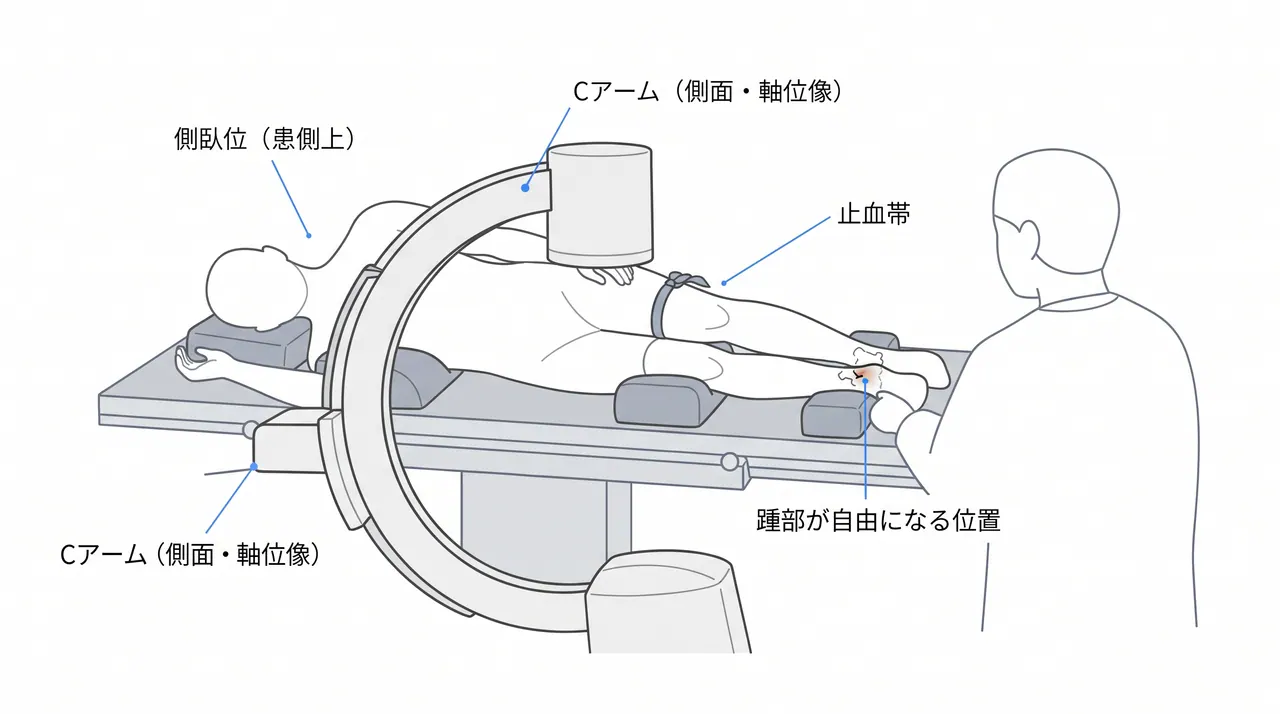 体位・透視設定 — 側臥位（患側上）・Cアーム配置・止血帯設置。術中透視で側面・軸位像確認が可能な配置