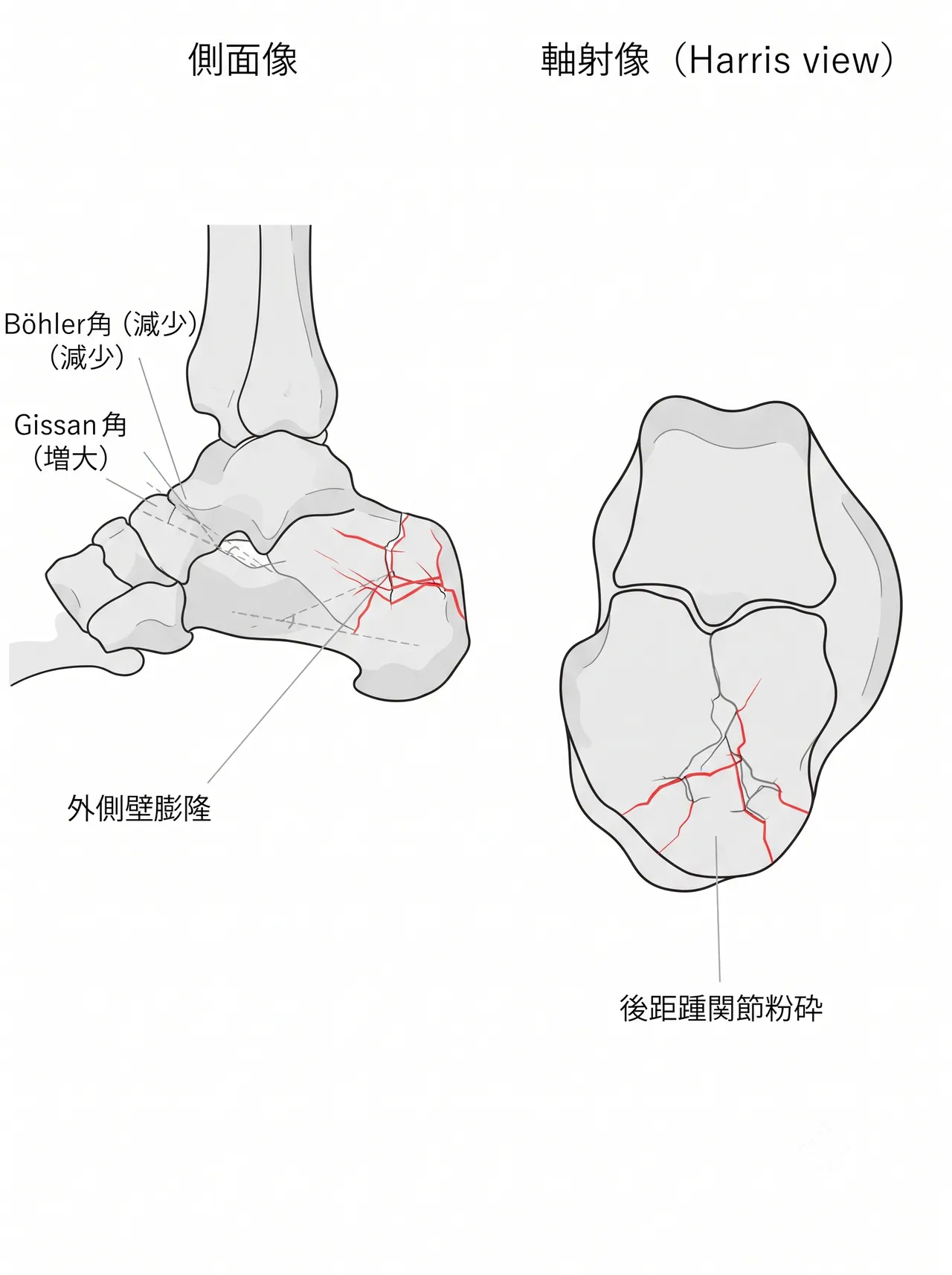 術前X線（側面像・Harris axial view） — Böhler角の減少・Gissane角の変化・踵骨短縮・外側壁膨隆を評価