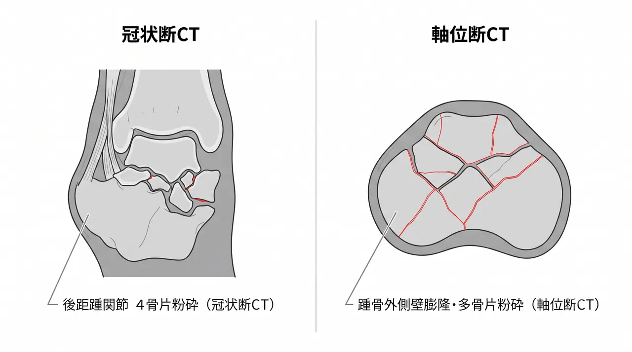 CT軸位断・冠状断 — 後距踵関節の4骨片以上の粉砕（Sanders IV）・距骨下陥没・外側壁膨隆の三次元評価