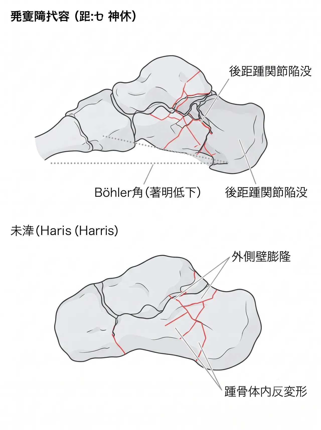 術前X線側面像・軸位像 — Böhler角消失・踵骨高さ短縮・外側壁膨隆・踵骨体内反変形を評価