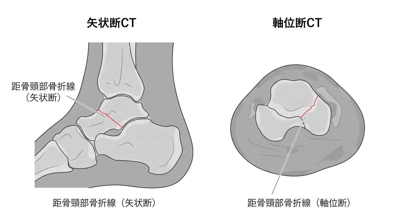 CT矢状断・軸位断 — 転位量の三次元評価・距骨下関節・距腿関節の関節面整合性確認