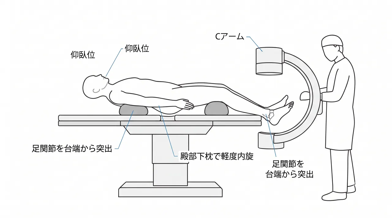 体位・透視設定 — 仰臥位・殿部挙上・足関節末端突出配置