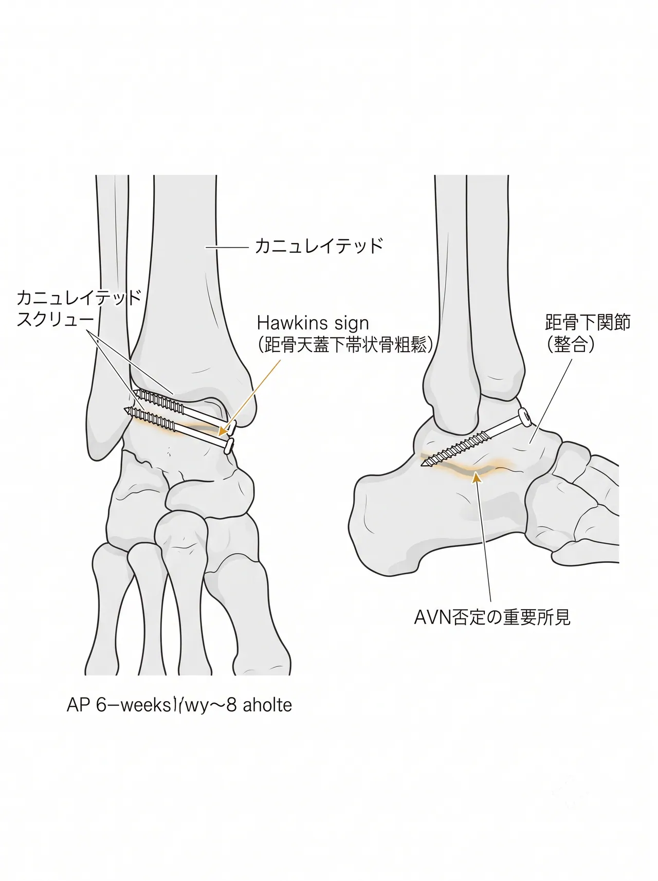 術後X線正面・側面像 — スクリュー位置・整復位・Hawkins sign評価（術後6〜8週）