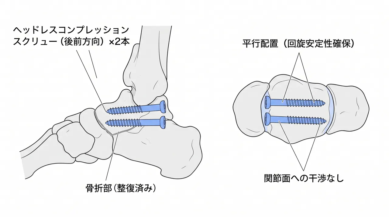 前内側アプローチによる距骨頸部展開・ヘッドレススクリュー後前方向固定（術中透視側面像）